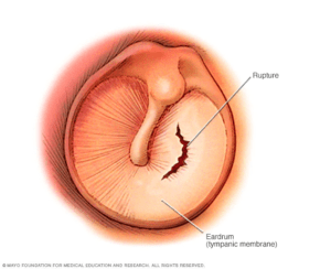 rupture ear drum